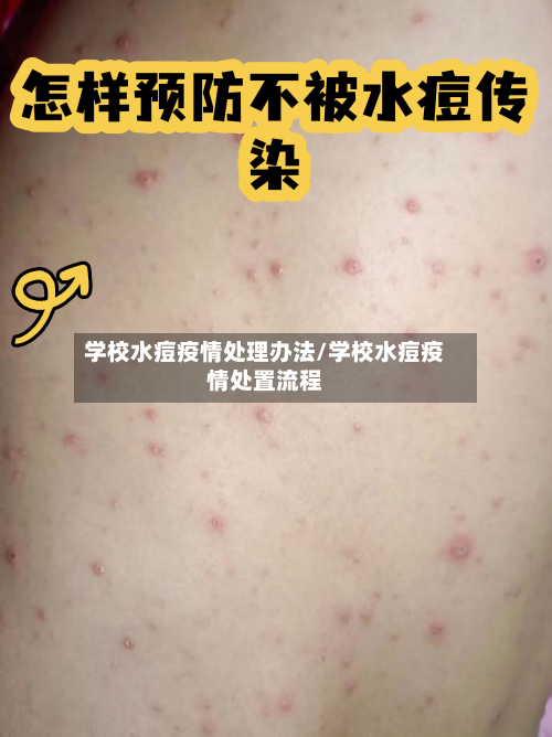 学校水痘疫情处理办法/学校水痘疫情处置流程